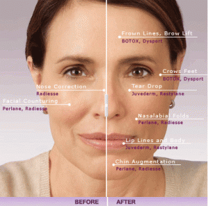 liquid-facelift-botox-and-fillers