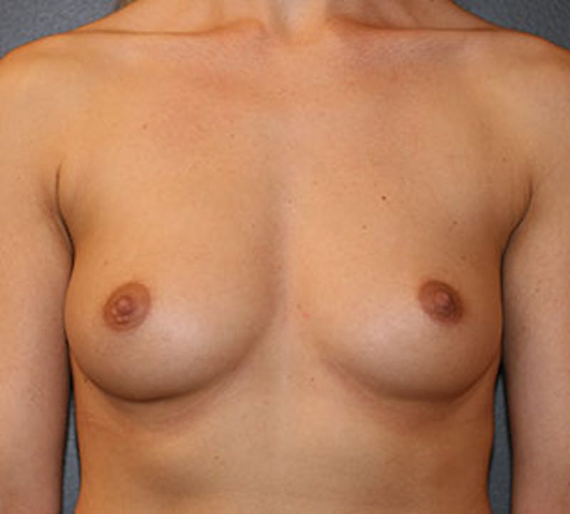Breast Augmentation Before & After Gallery - Patient 12163556 - Image 1
