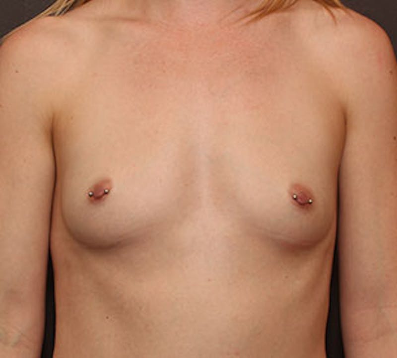 Breast Augmentation Before & After Gallery - Patient 12163576 - Image 1