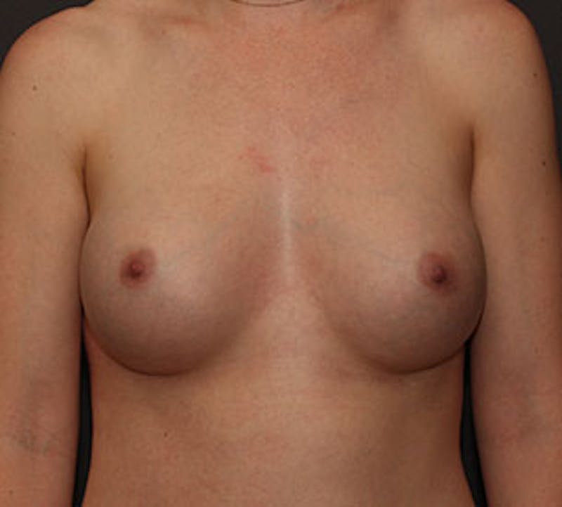 Breast Augmentation Before & After Gallery - Patient 12163576 - Image 2
