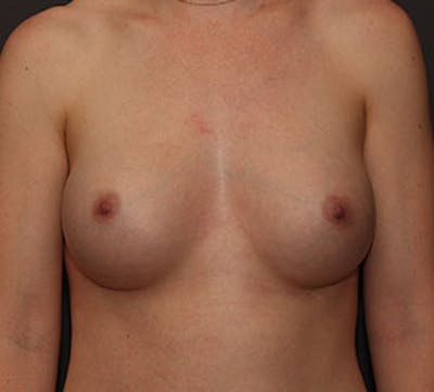 Breast Augmentation Before & After Gallery - Patient 12163576 - Image 2