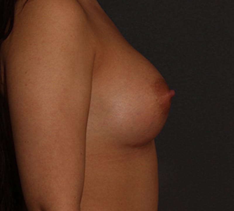 Breast Augmentation Gallery - Patient 12163578 - Image 8