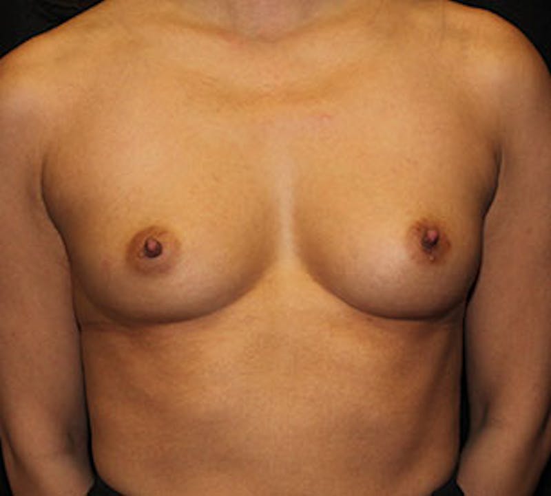 Breast Augmentation Before & After Gallery - Patient 12163583 - Image 1