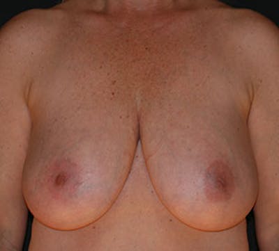 乳房缩小和乳房固定术(提升)前后画廊-患者12163592 -图1