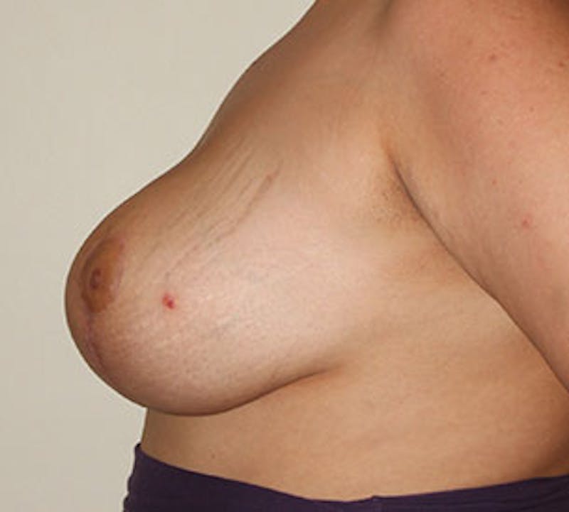 Breast Reduction and Mastopexy (Lift) Before & After Gallery - Patient 12163596 - Image 10
