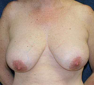乳房缩小和乳房固定术(提升)前后图片库-患者12163599 -图1