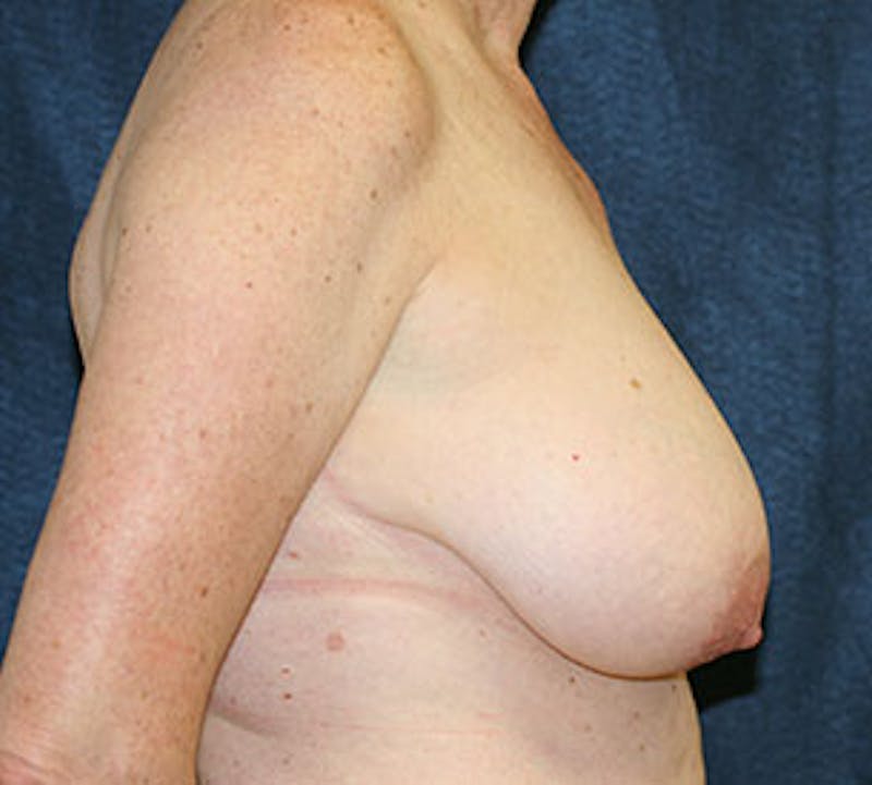 Breast Reduction and Mastopexy (Lift) Before & After Gallery - Patient 12163599 - Image 7