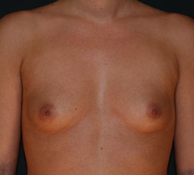 Breast Augmentation Before & After Gallery - Patient 12163600 - Image 1