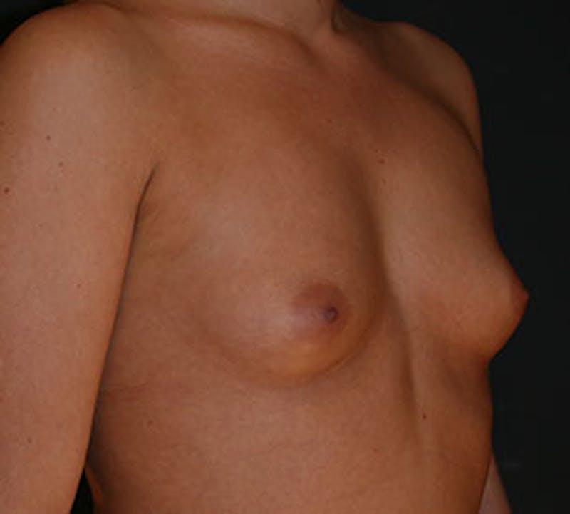 Breast Augmentation Before & After Gallery - Patient 12163600 - Image 3