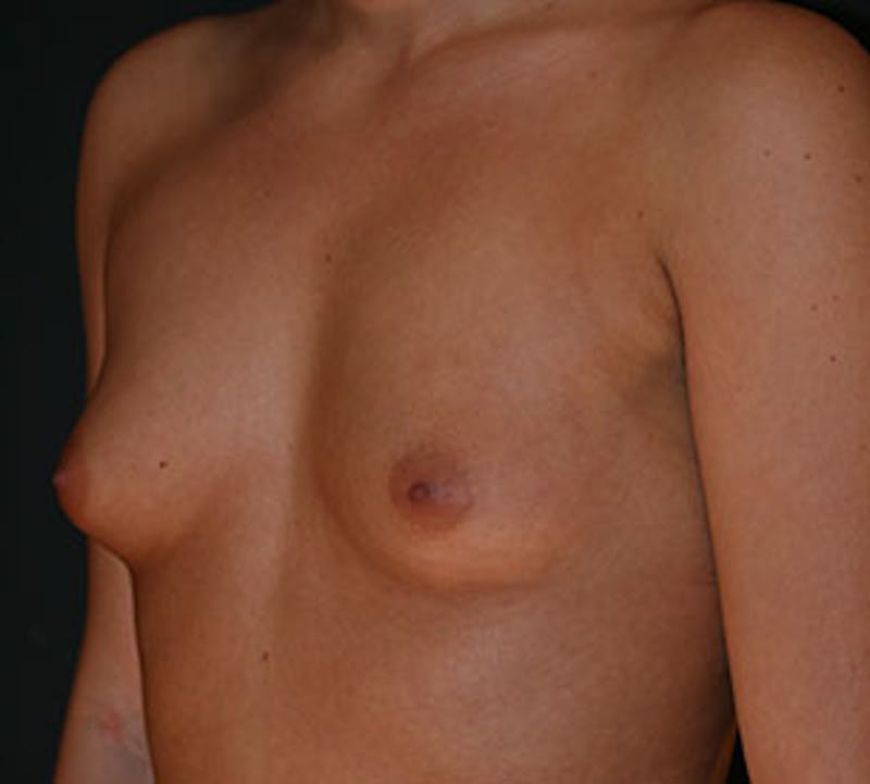 Breast Augmentation Before & After Gallery - Patient 12163600 - Image 5