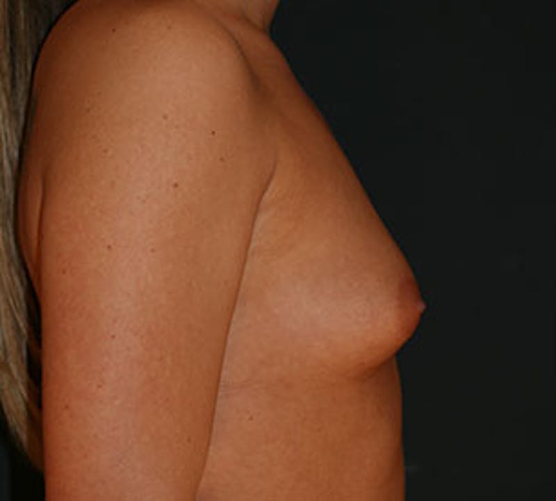 Breast Augmentation Before & After Gallery - Patient 12163600 - Image 7