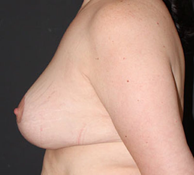 Augmentation-Mastopexy (Implant with Lift) Before & After Gallery - Patient 12163601 - Image 10