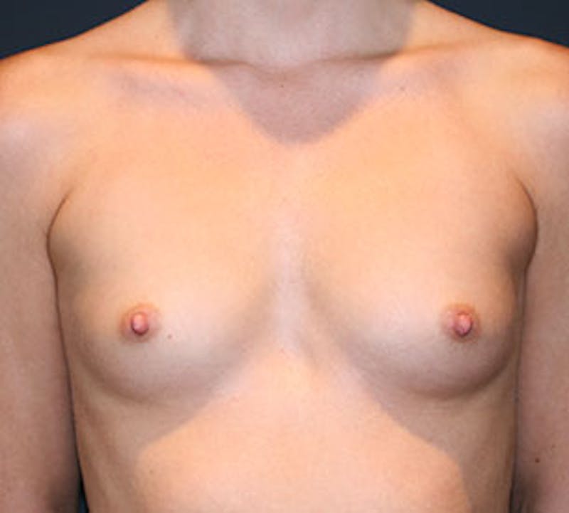Breast Augmentation Before & After Gallery - Patient 12163604 - Image 1