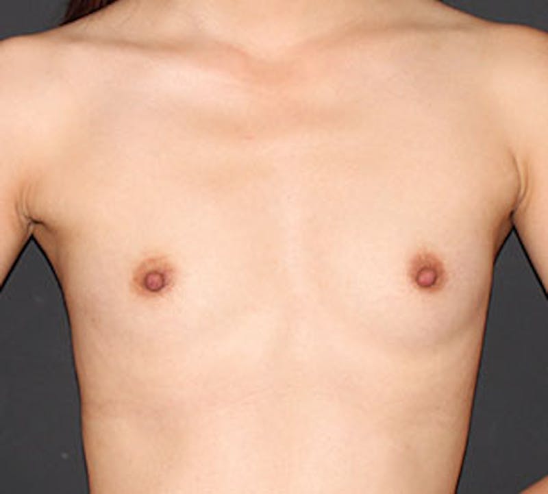 Breast Augmentation Before & After Gallery - Patient 12163607 - Image 1