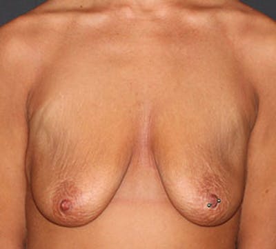 Augmentation-Mastopexy (Implant with Lift) Before & After Gallery - Patient 12163608 - Image 1