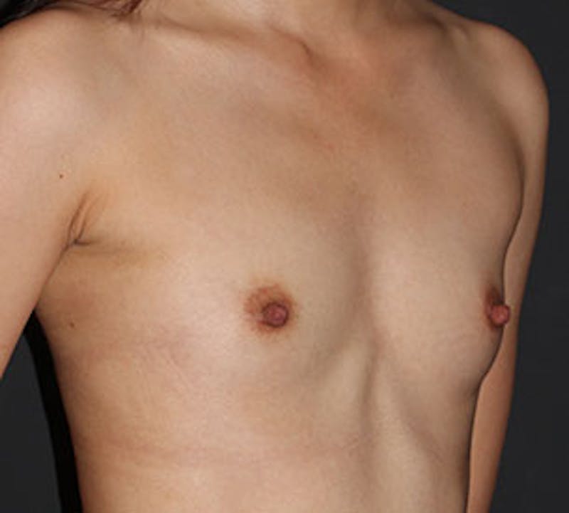 Breast Augmentation Before & After Gallery - Patient 12163607 - Image 3