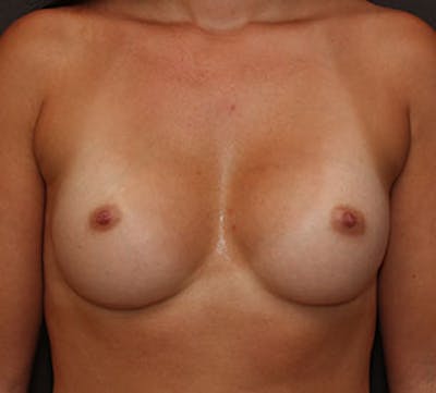 Breast Augmentation Before & After Gallery - Patient 12163613 - Image 2
