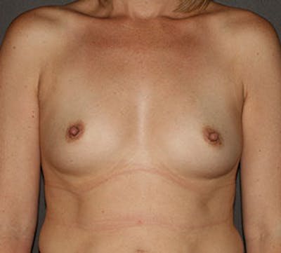 Breast Augmentation Before & After Gallery - Patient 12167681 - Image 1