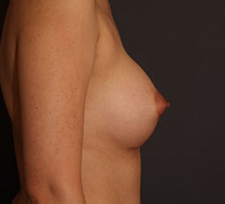 Breast Augmentation Before & After Gallery - Patient 12167682 - Image 8