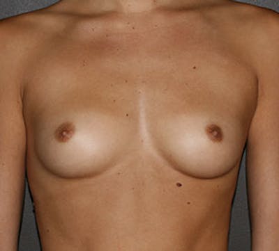 Breast Augmentation Before & After Gallery - Patient 12167701 - Image 1