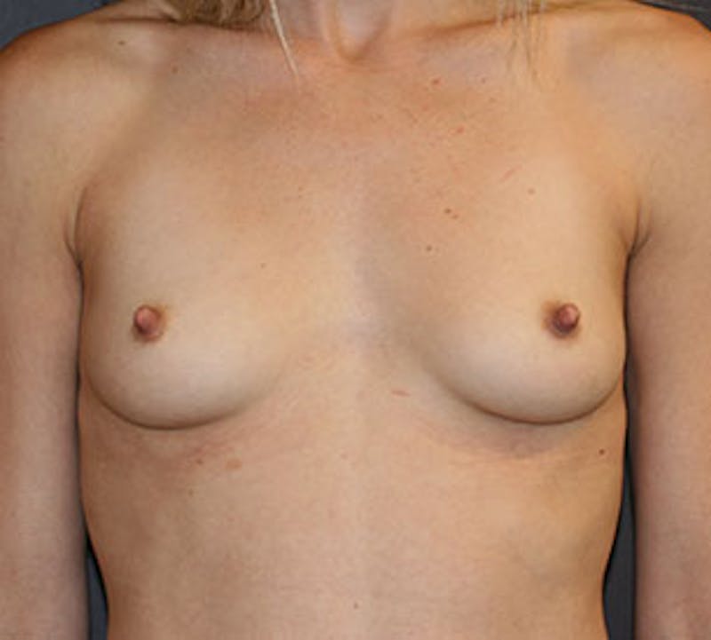 Breast Augmentation Before & After Gallery - Patient 12167715 - Image 1