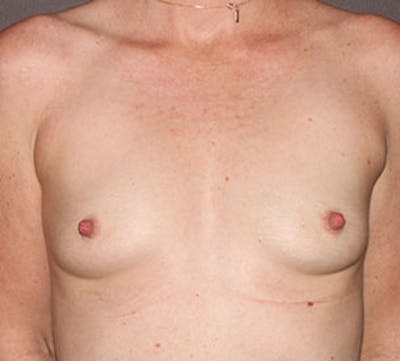 Breast Augmentation Before & After Gallery - Patient 12167754 - Image 1