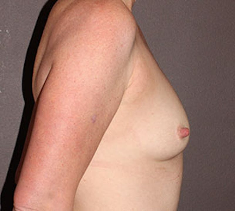Breast Augmentation Before & After Gallery - Patient 12167754 - Image 7