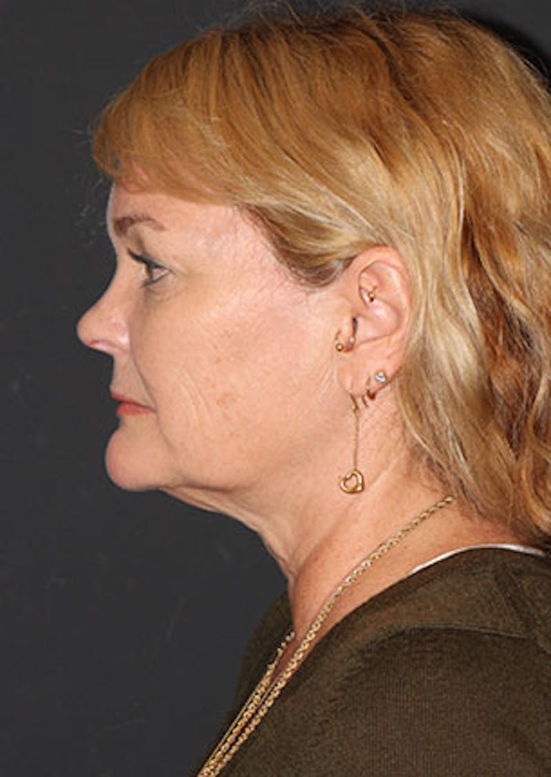 Facelift/Necklift Before & After Gallery - Patient 12735985 - Image 11