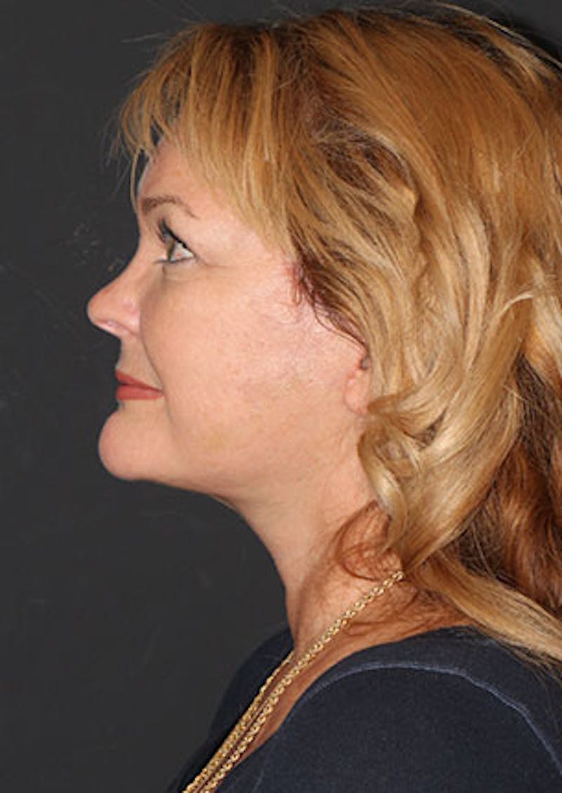 Facelift/Necklift Before & After Gallery - Patient 12735985 - Image 12