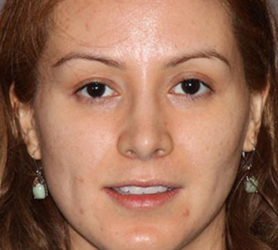 Lip Augmentation Before & After Gallery - Patient 12735987 - Image 1