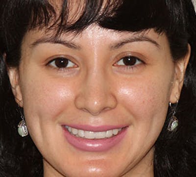 Lip Augmentation Before & After Gallery - Patient 12735987 - Image 2