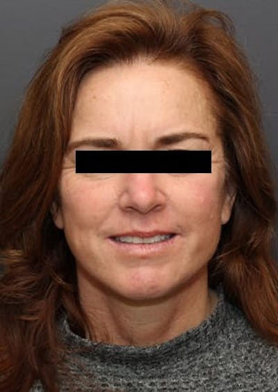 Facelift/Necklift Before & After Gallery - Patient 12735988 - Image 2