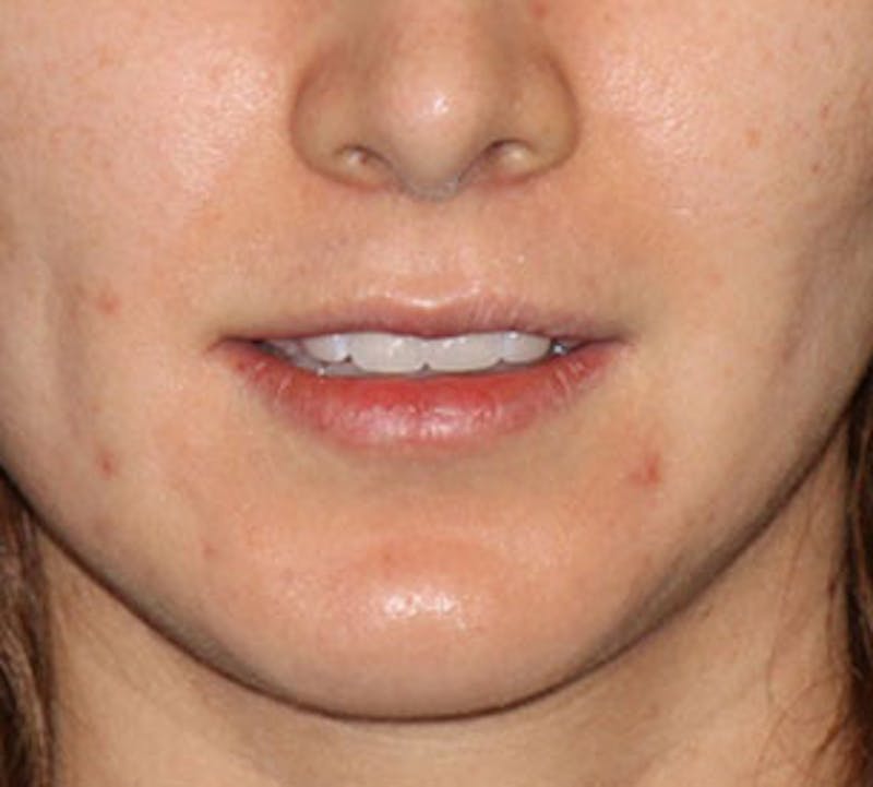 Lip Augmentation Before & After Gallery - Patient 12735987 - Image 3