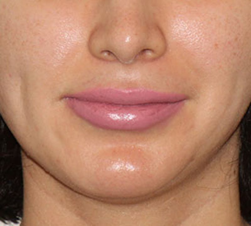 Lip Augmentation Before & After Gallery - Patient 12735987 - Image 4