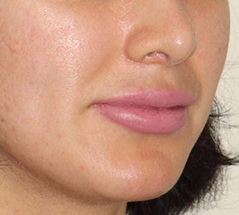 Lip Augmentation Before & After Gallery - Patient 12735987 - Image 6