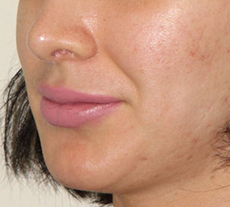Lip Augmentation Before & After Gallery - Patient 12735987 - Image 8
