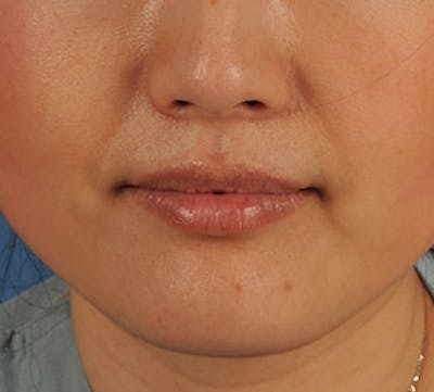 Lip Augmentation Before & After Gallery - Patient 12735989 - Image 1