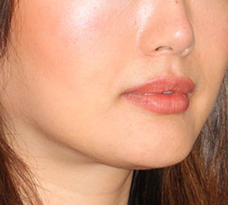 Lip Augmentation Before & After Gallery - Patient 12735989 - Image 4