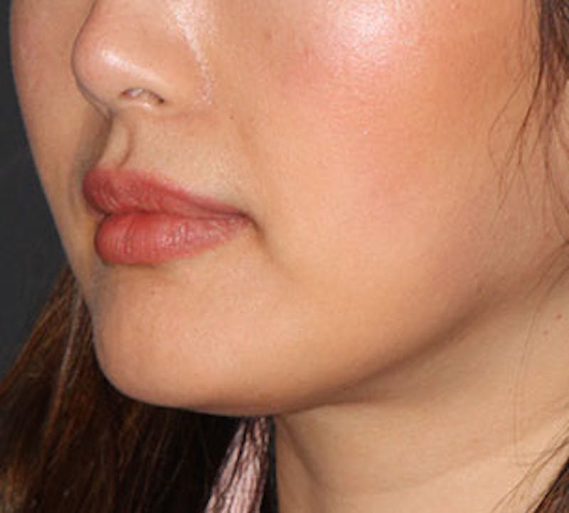 Lip Augmentation Before & After Gallery - Patient 12735989 - Image 6
