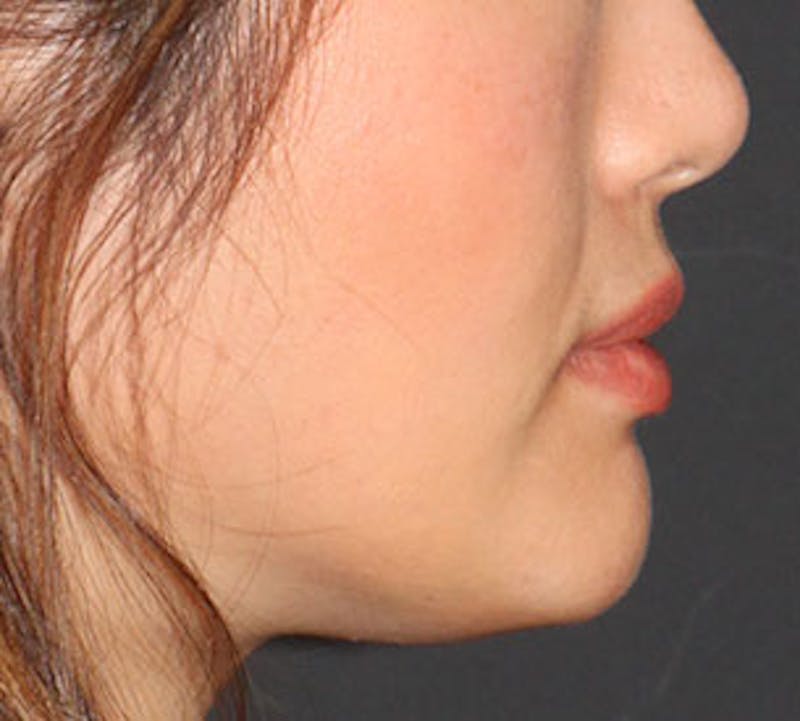 Lip Augmentation Before & After Gallery - Patient 12735989 - Image 8