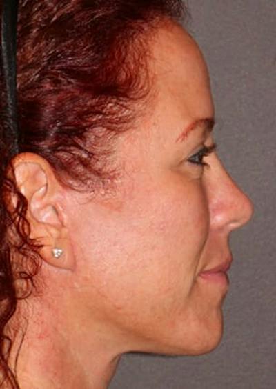 Facelift/Necklift Before & After Gallery - Patient 12735990 - Image 2