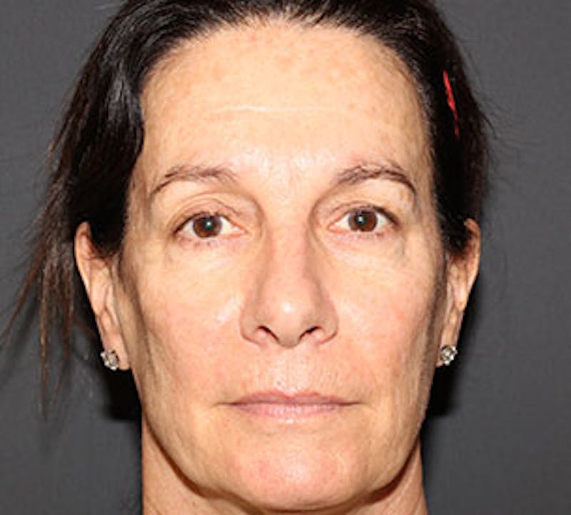 Blepharoplasty Before & After Gallery - Patient 12736000 - Image 1