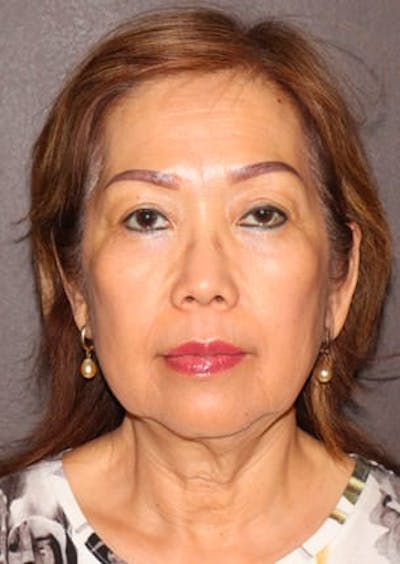 Facelift/Necklift Before & After Gallery - Patient 12736001 - Image 1