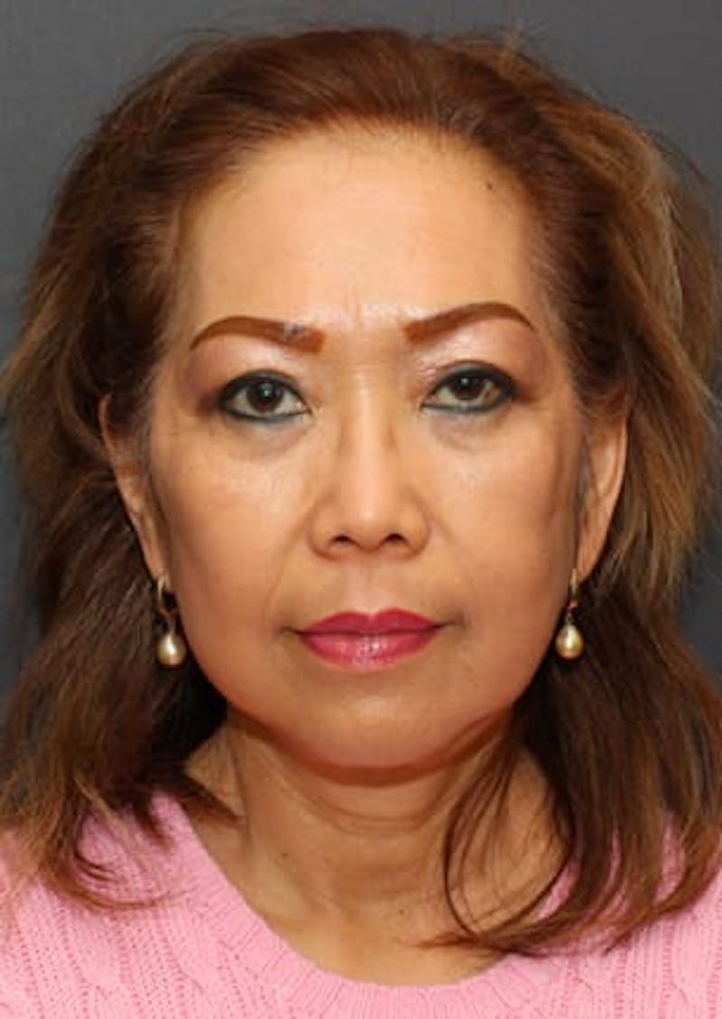 Facelift/Necklift Before & After Gallery - Patient 12736001 - Image 2