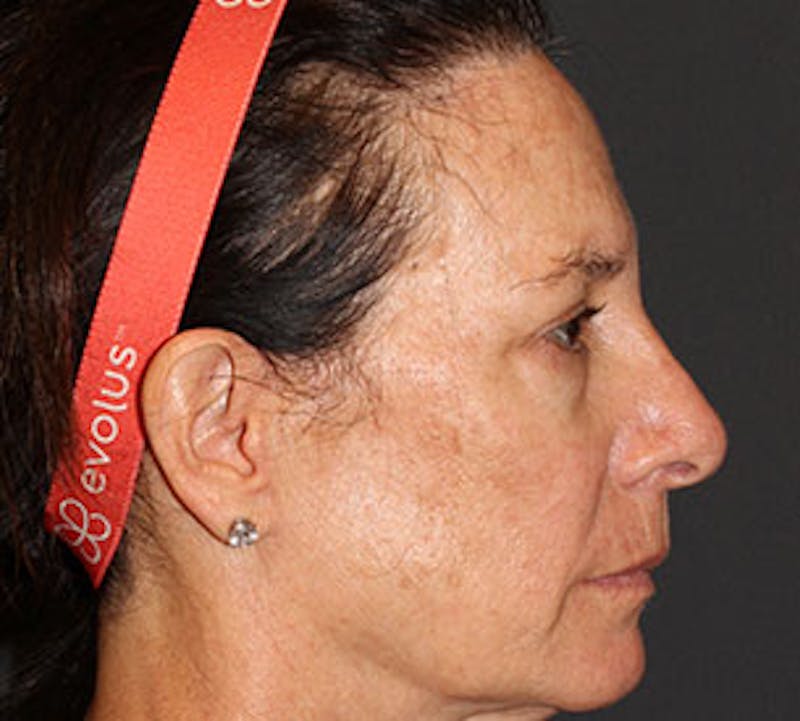 Blepharoplasty Before & After Gallery - Patient 12736000 - Image 6
