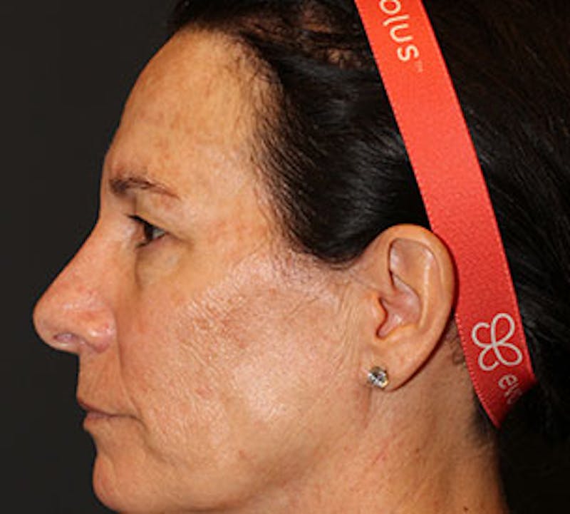 Blepharoplasty Before & After Gallery - Patient 12736000 - Image 9