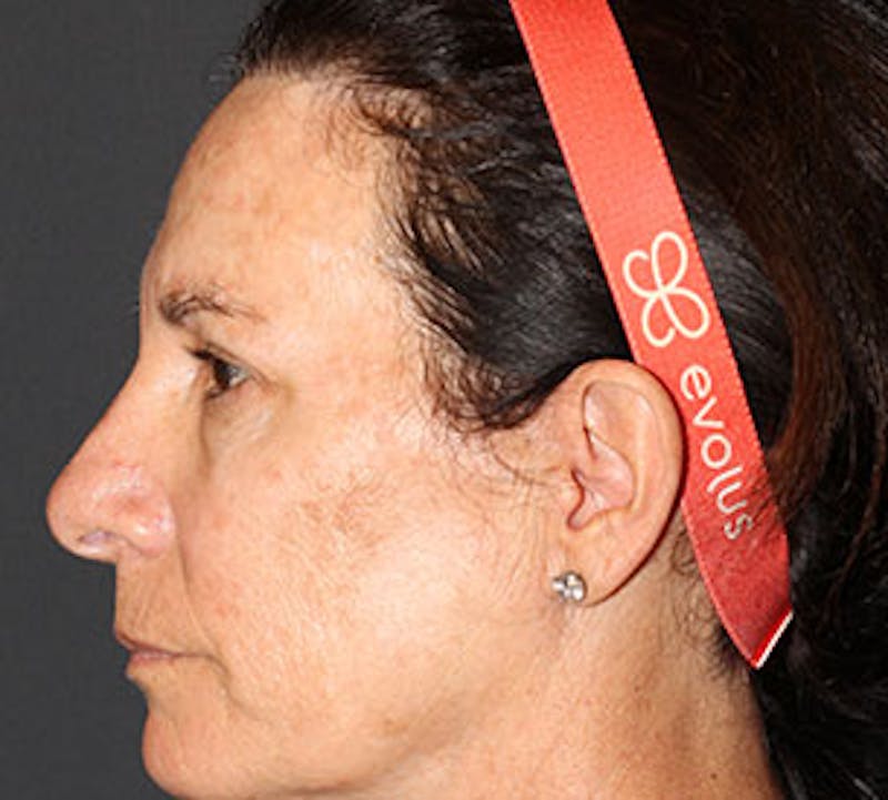 Blepharoplasty Before & After Gallery - Patient 12736000 - Image 10