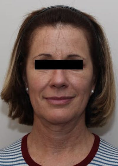 Facelift/Necklift Before & After Gallery - Patient 12736005 - Image 1