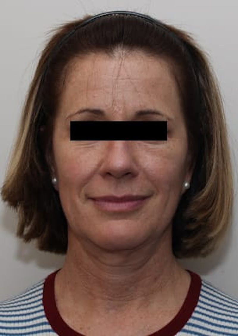 Facelift/Necklift Before & After Gallery - Patient 12736005 - Image 1