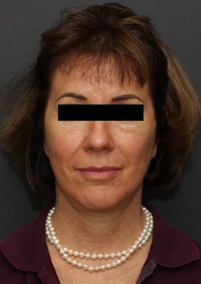 Facelift/Necklift Before & After Gallery - Patient 12736005 - Image 2